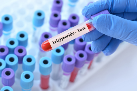 Image of test tubes and hand holding one with a label that says Triglyceride - Test